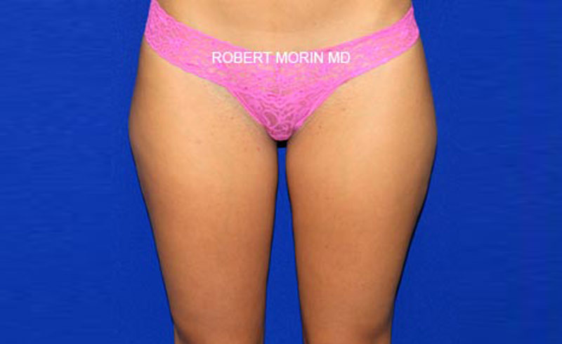 Liposuction . Before Treatment photo - female patient 1