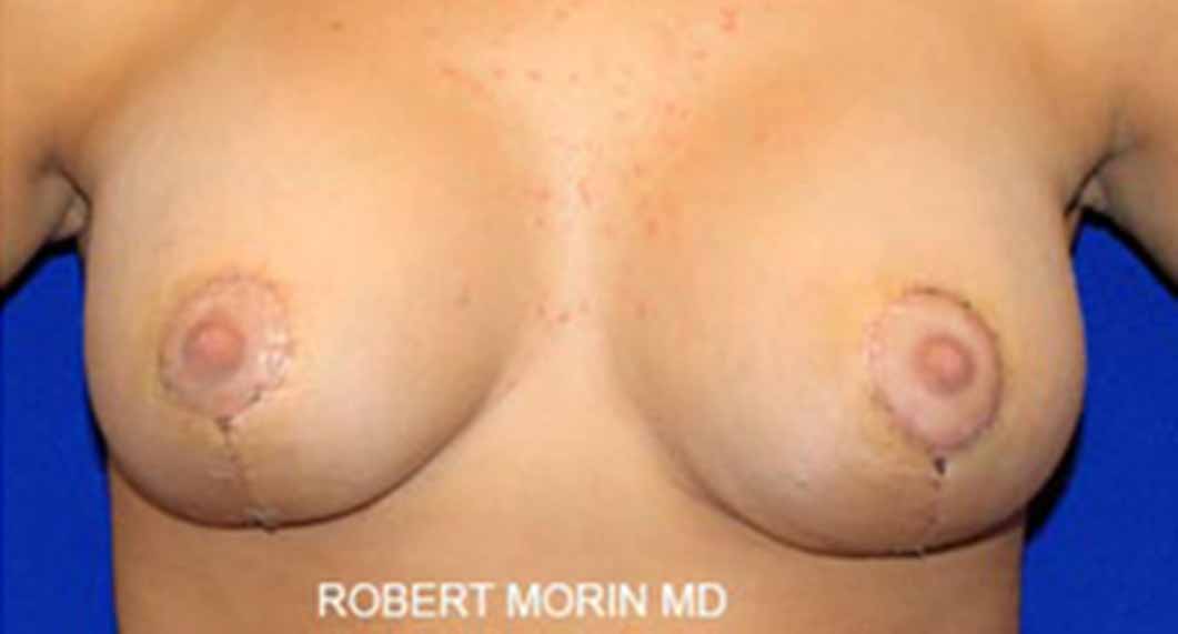 Mastopexy Surgery. After Treatment photo - female patient 1