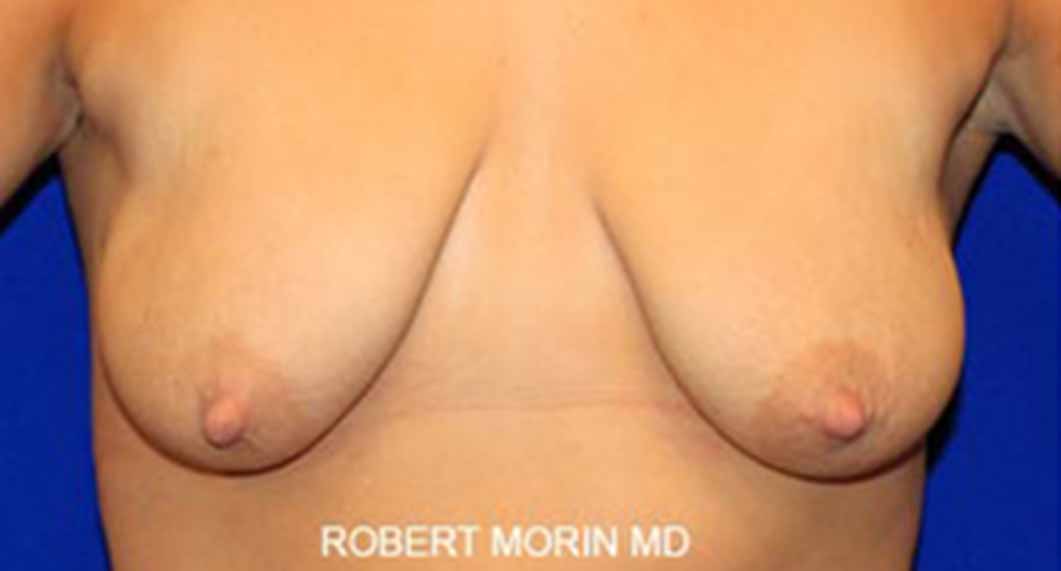 Mastopexy Surgery. Before Treatment photo - female patient 1