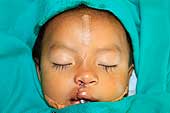 Surgical Mission: little child after operation