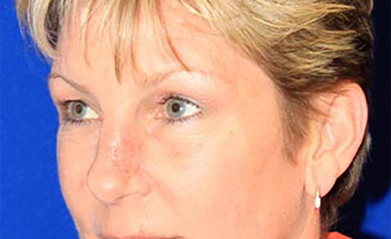SKIN CANCER EXCISION, after treatment photo