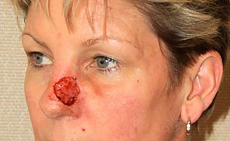 SKIN CANCER EXCISION, Before treatment photo