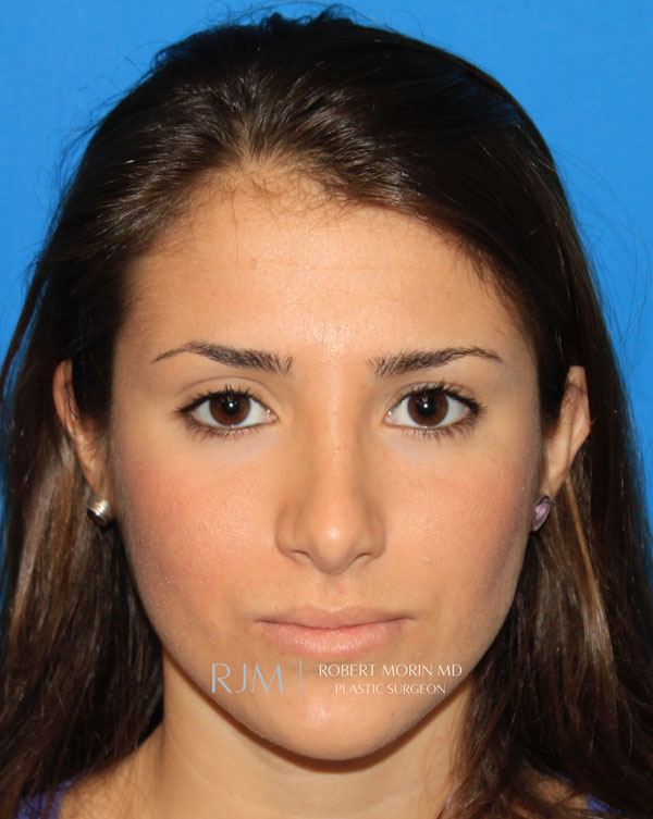 rhinoplasty