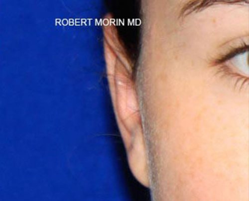 Otoplasty. After Treatment photo - patient 1