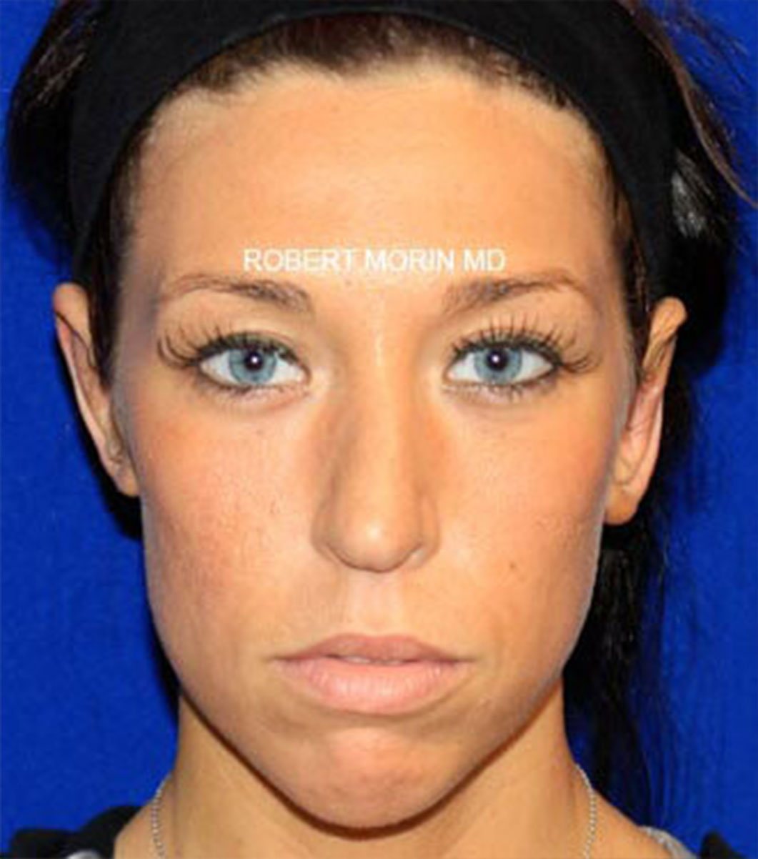 Otoplasty. After Treatment photo - patient 4