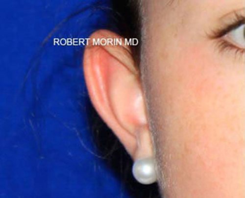 Otoplasty. Before Treatment photo - patient 1