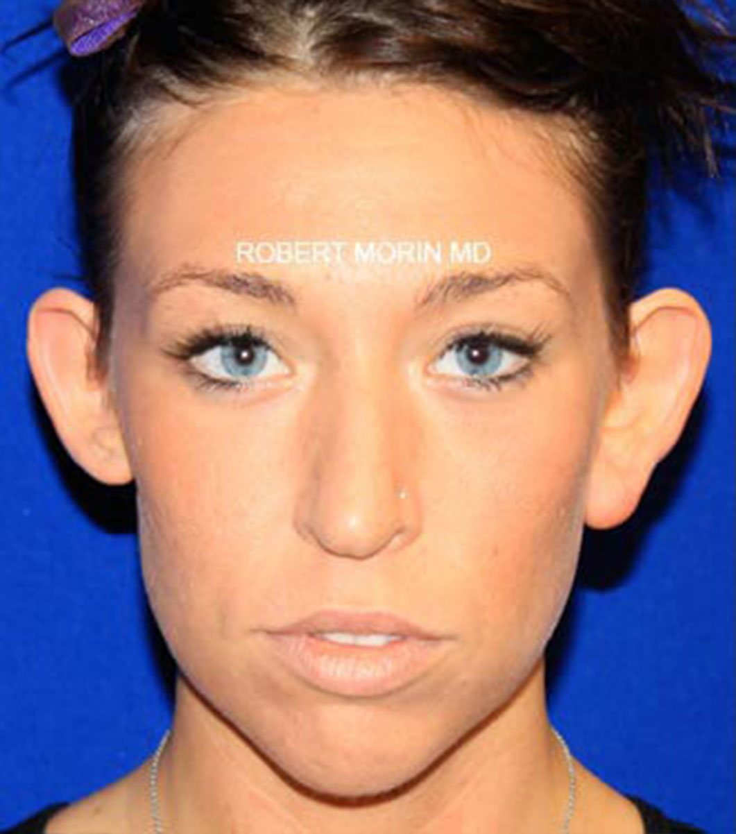 Otoplasty. Before Treatment photo - patient 4