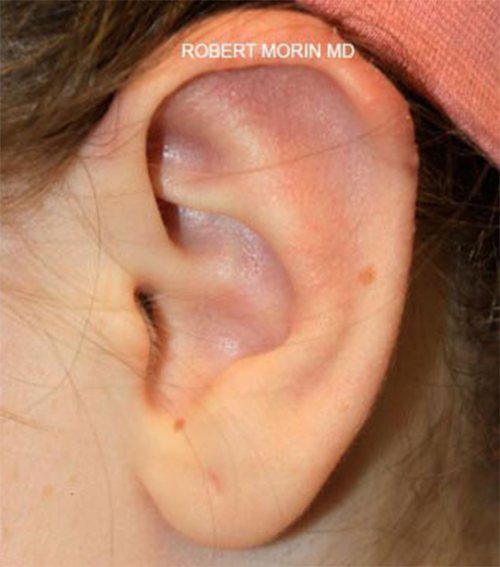 Otoplasty. After Treatment photo - patient 3