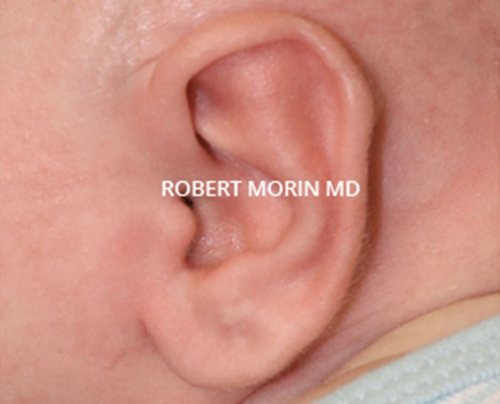 Otoplasty. After Treatment photo - patient 2