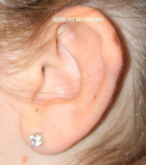 Otoplasty. Before Treatment photo - patient 3
