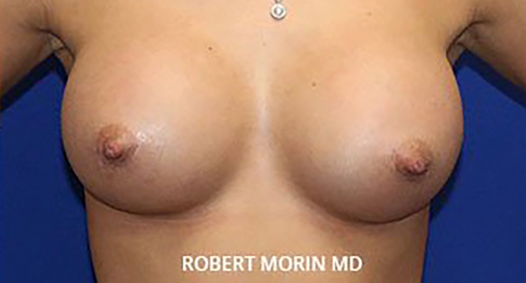 Breast Augmentation. After Treatment photo - female patient 1