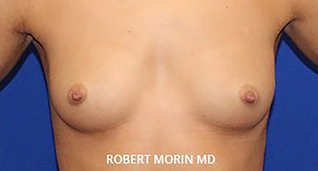 Breast Augmentation. Before Treatment photo - female patient 1