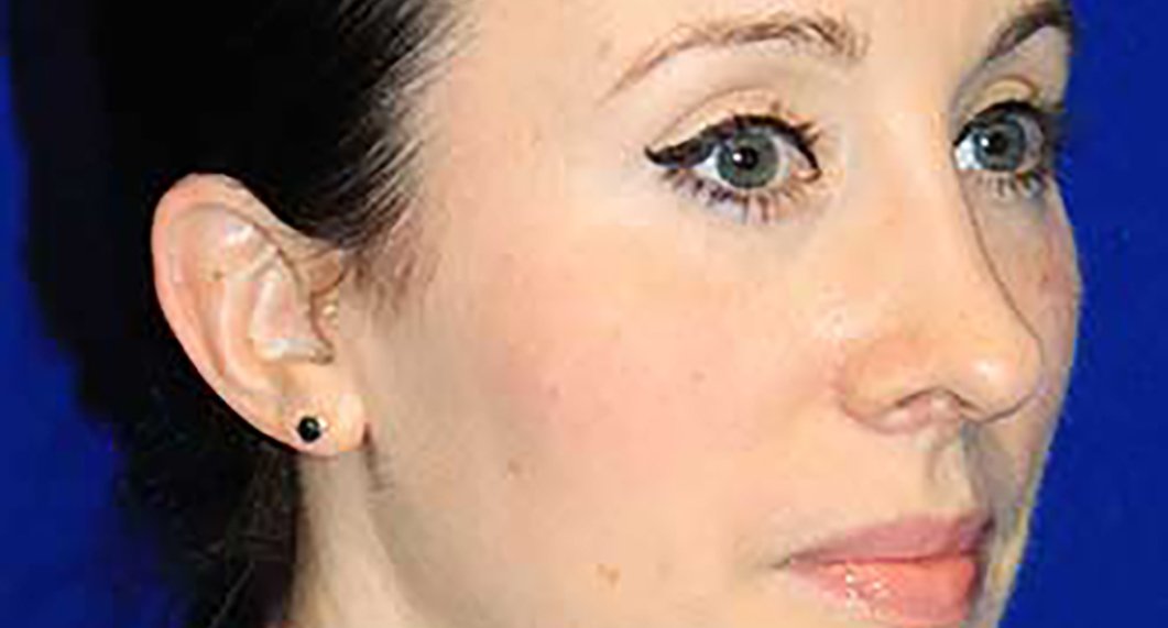 After Treatment photo - Revision Rhinoplasty - female patient 1