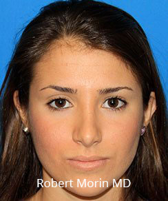 After Rhinoplasty Treatment photo - female patient 1