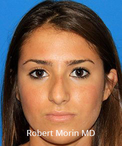 Before Rhinoplasty Treatment photo - female patient 1