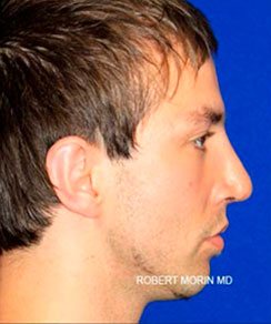 After Treatment photo - Rhinoplasty - patient 2