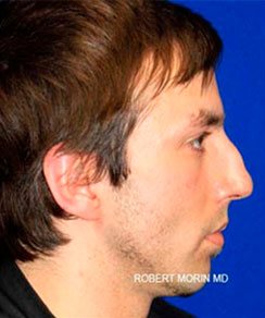 Before Treatment photo - Rhinoplasty - patient 2