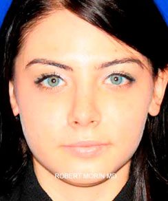 After Rhinoplasty Treatment photo - patient 3