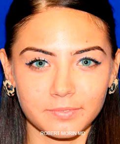 Before Rhinoplasty Treatment photo - patient 3
