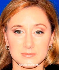 After Rhinoplasty Treatment photo - patient 4