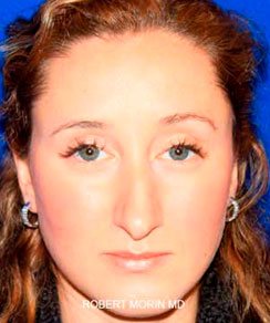 Before Rhinoplasty Treatment photo - patient 4