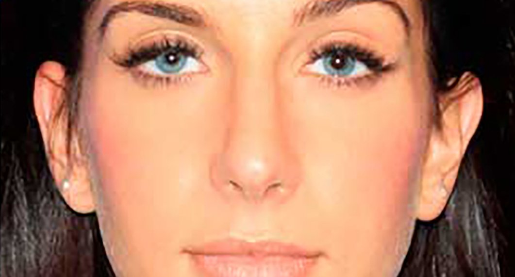 After Treatment photo - Rhinoplasy - female patient 3