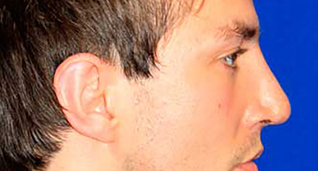 After Treatment photo - Rhinoplasy - male patient 4