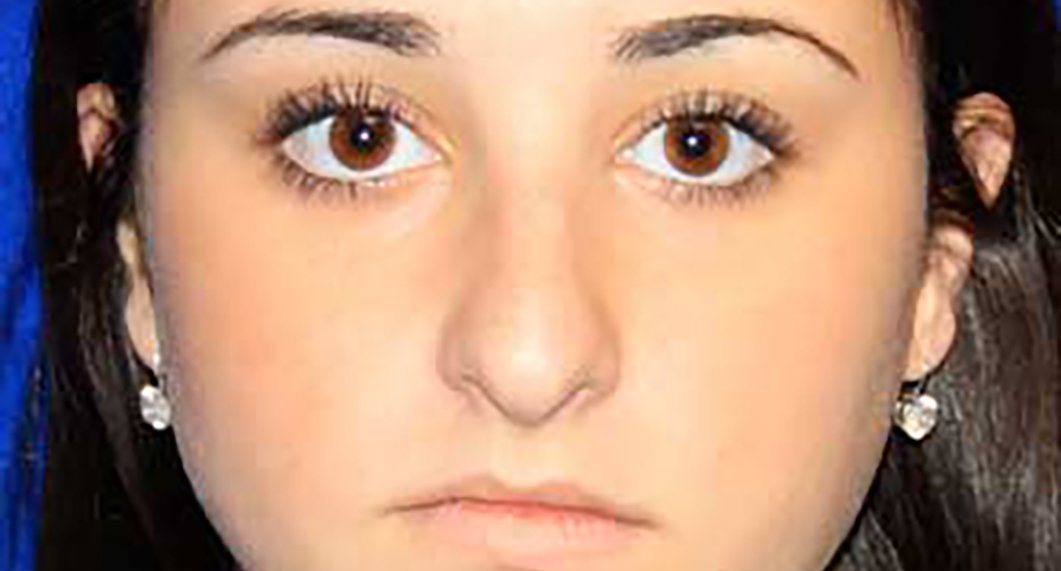 Before Treatment photo - Rhinoplasy - female patient 2