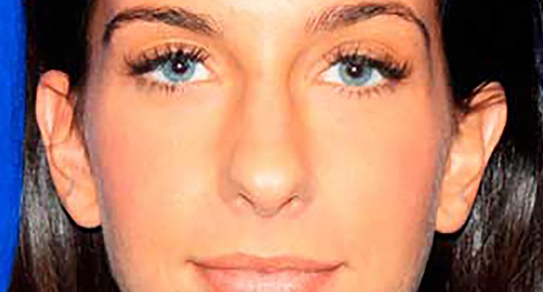 Before Treatment photo - Rhinoplasy - female patient 3