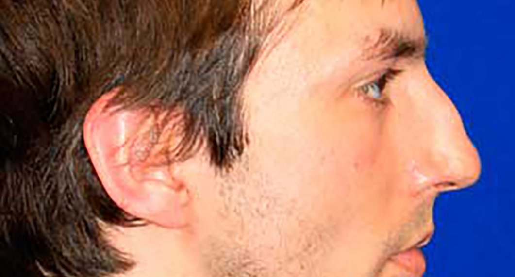 Before Treatment photo - Rhinoplasy - male patient 4