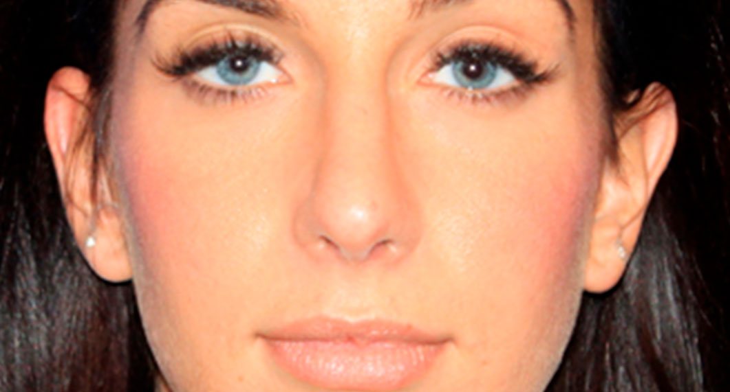 After Treatment photo - Rhinoplasty - female patient 3