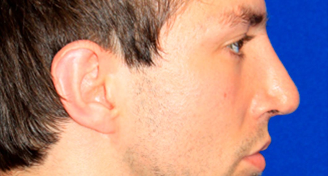 After Treatment photo - Rhinoplasty - male patient 4