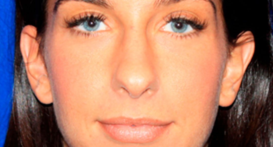Before Treatment photo - Rhinoplasty - female patient 3