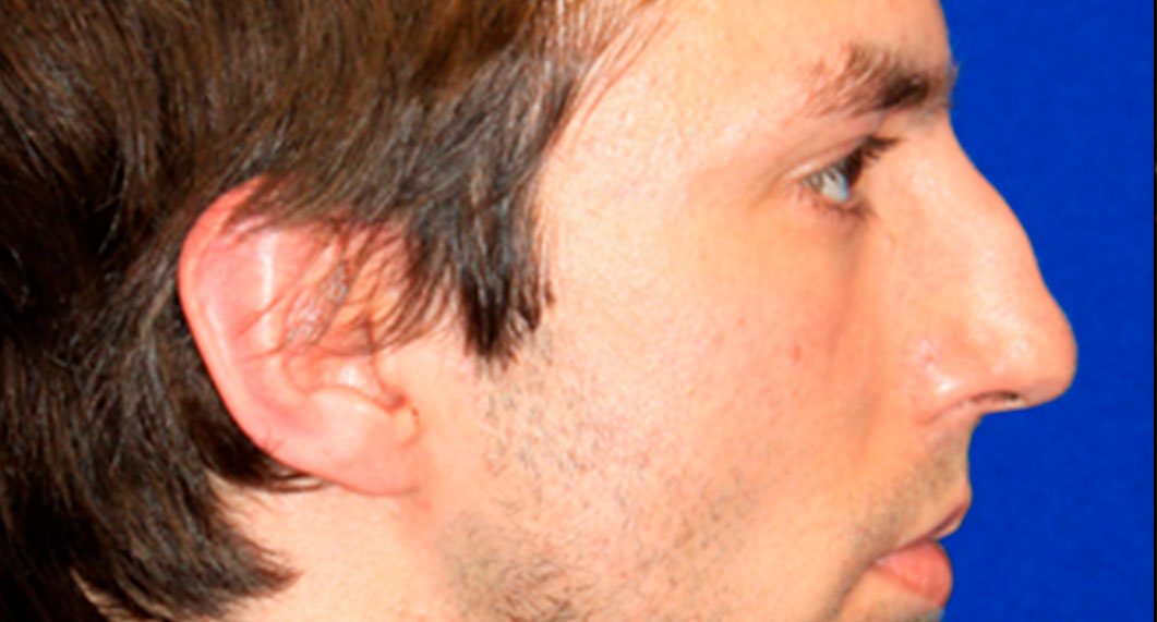 Before Treatment photo - Rhinoplasty - male patient 4