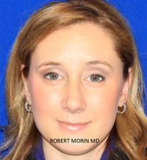 Rhinoplasty Recovery - After 14 days