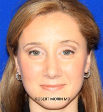 Rhinoplasty Recovery - After 30 days