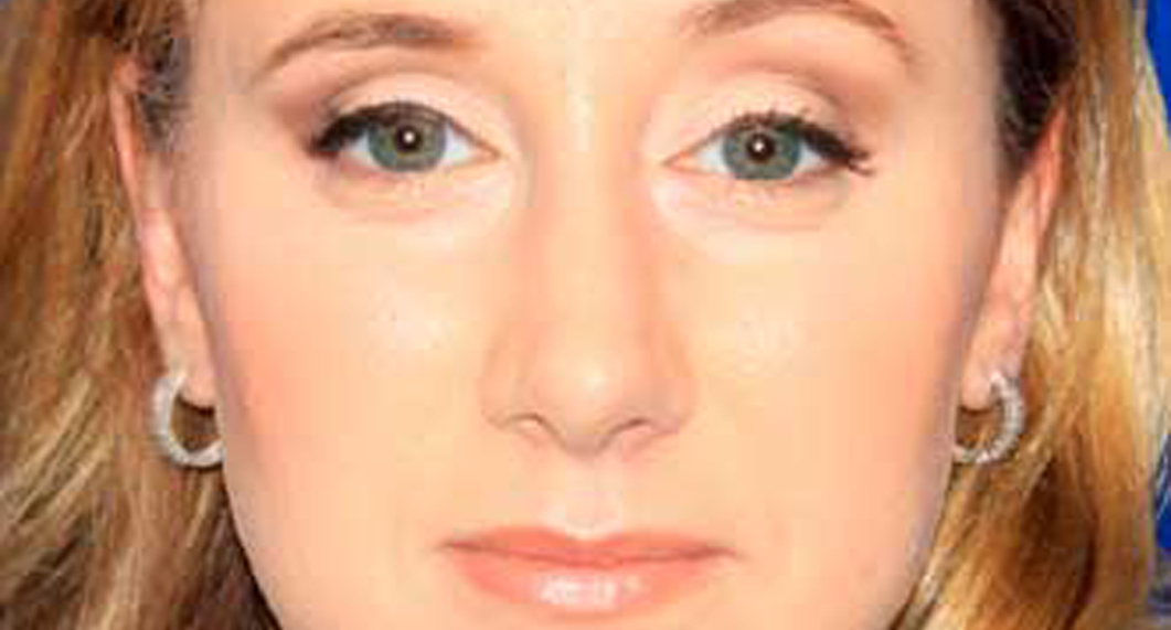 Woman's face, After Rhinoplasty and Septoplasty nose Treatment, front view, female patient 1