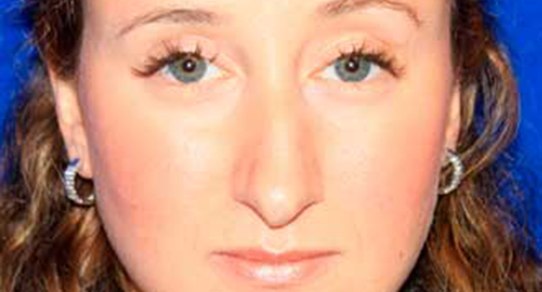 Woman's face, Before Rhinoplasty and Septoplasty nose Treatment, front view, female patient 1