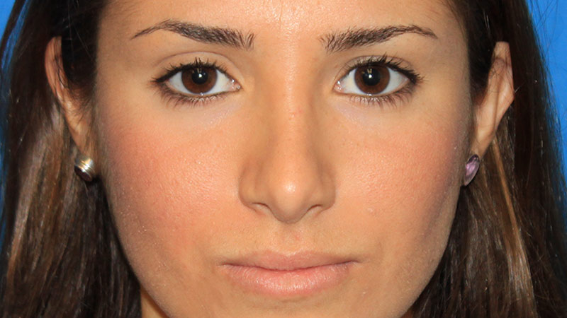 Ultrasound Rhinoplasty. After Treatment photo - patient 1