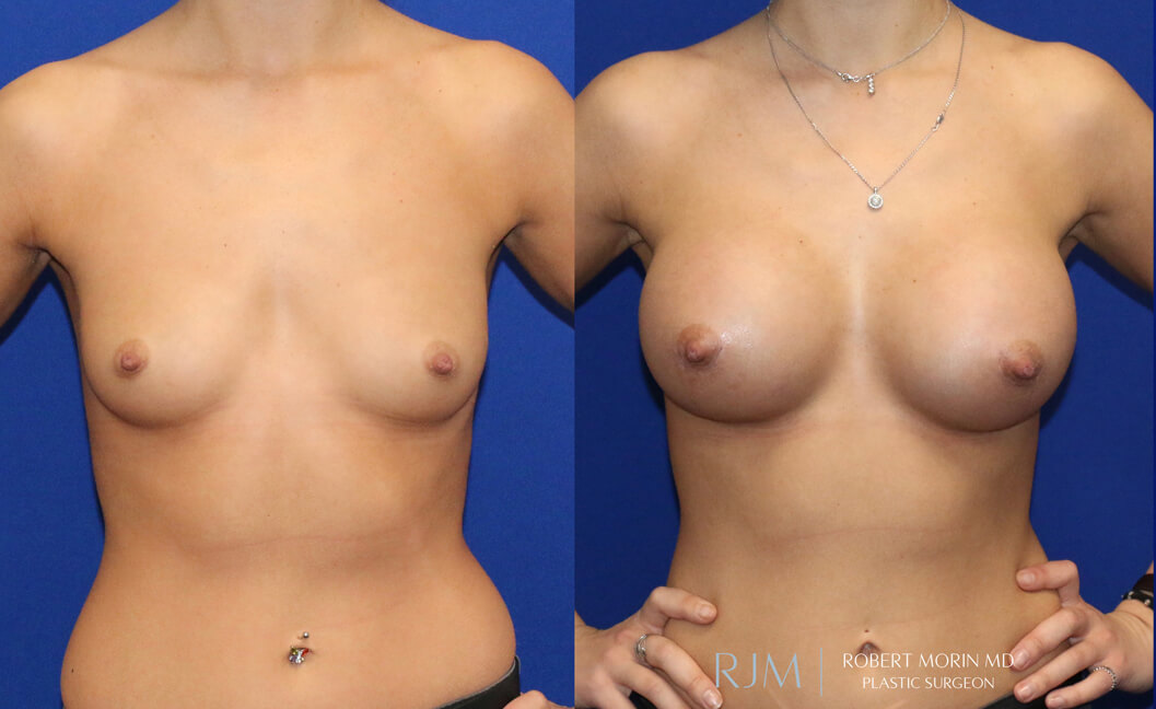 Woman's breasts, Before Infra-Areolar Incision Breast Augmentation Treatment, front view, patient 1
