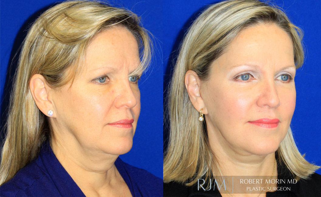 Woman's face, before and after Facelift Surgery treatment, oblique view, patient 1