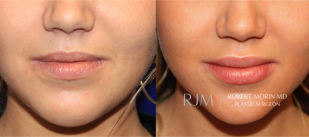 Lip augmentation. Before & After Photos