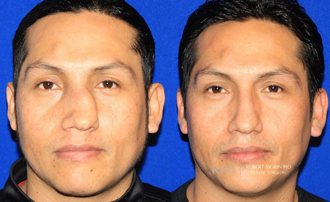 Male face, broken nose, before and after treatment, front view