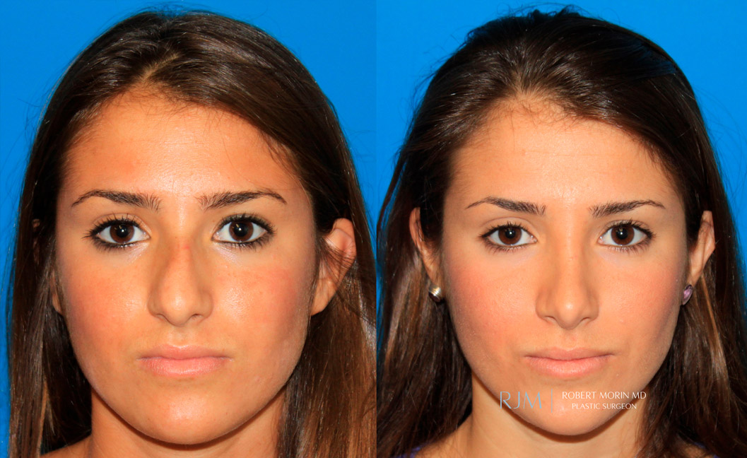 Ultrasonic Rhinoplasty Before & After Photos