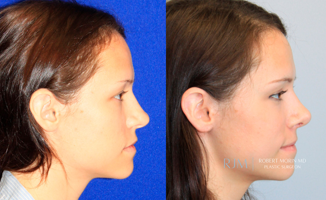 Woman's face, before and after Rhinoplasty treatment, side view, patient 2
