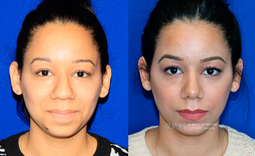 Female face, before and after Rhinoplasty treatment, front view, patient 5
