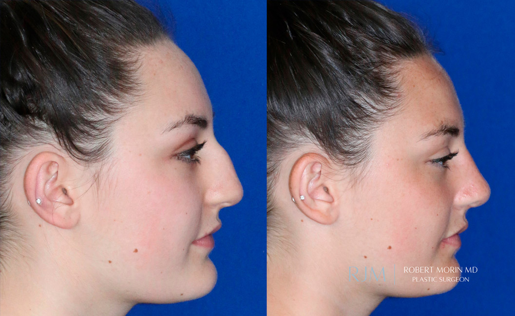 Female face, before and after Rhinoplasty treatment, side view, patient 6