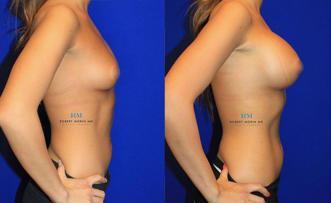 Before & After Breast Augmentation