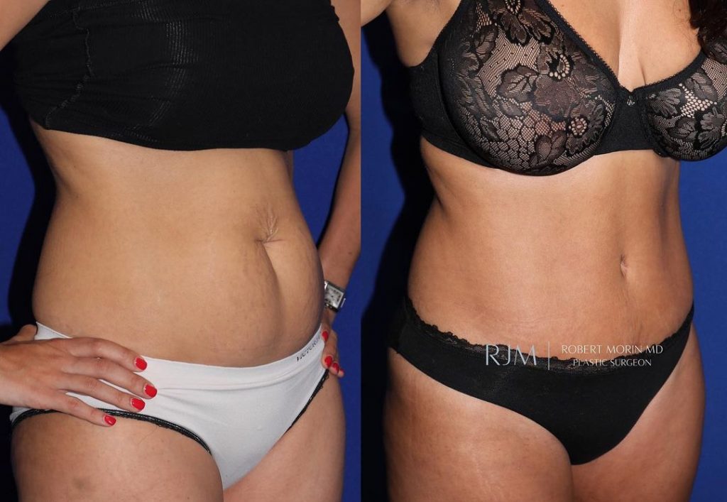 Woman's body, before and after: tummy tuck and liposuction treatment, oblique view