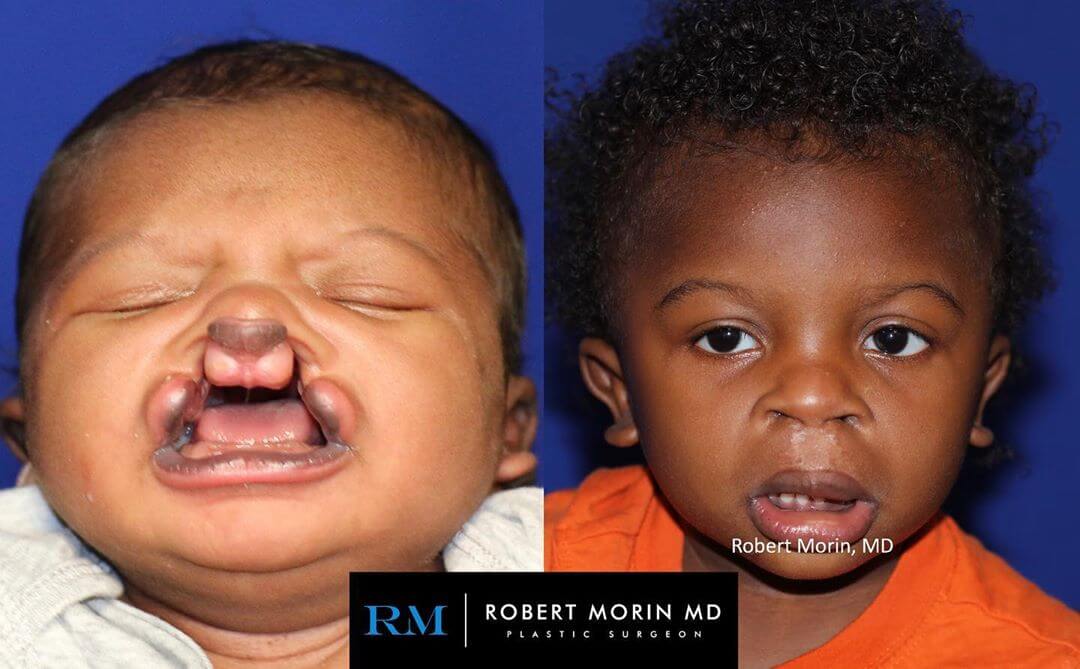 Child’s face, before and after Cleft Lip and Palate Journey treatment, front view